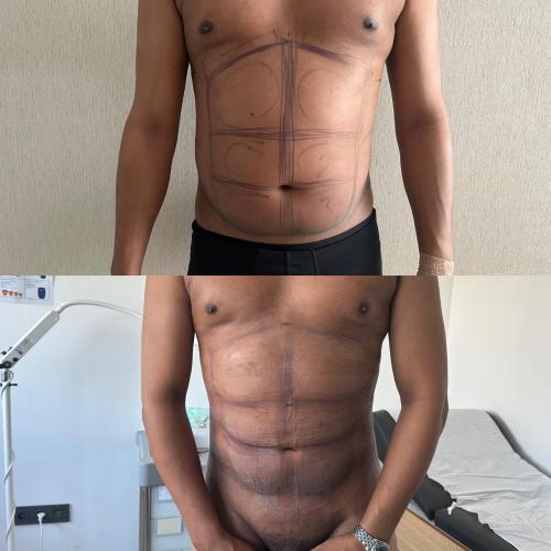 Tratamiento de ginecomastia (con liposucción) Foto antes/después